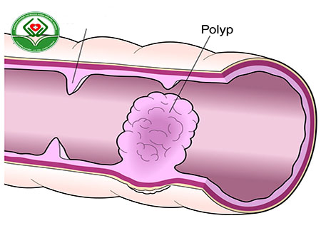 tác hại bệnh polyp hậu môn