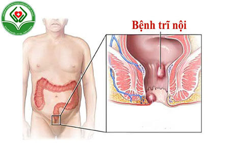 Hiểu hơn bệnh trĩ nội là gì