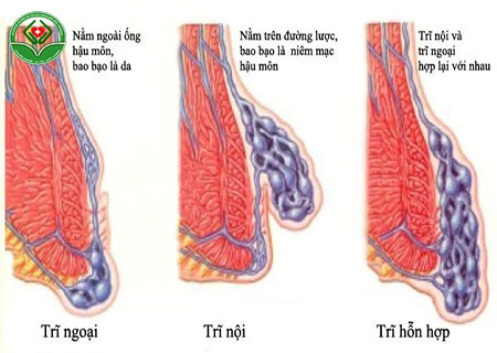 phân loại trĩ
