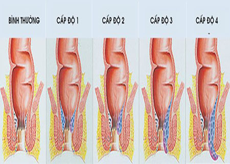 các cấp độ của trĩ nội