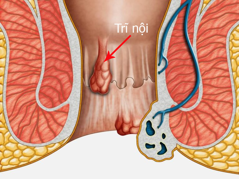 Bệnh trĩ nội là gì ? Bệnh trĩ nội là gì ?