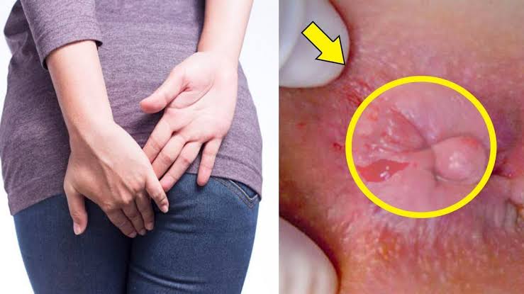 Bệnh trĩ ở chị em phụ nữ Bệnh trĩ ở chị em phụ nữ