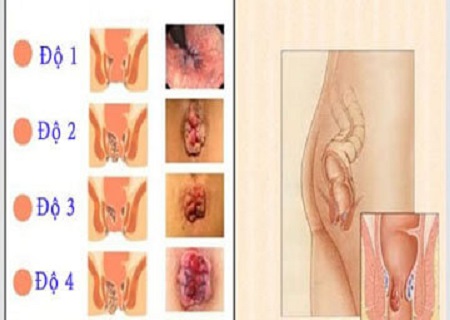 Bệnh trĩ gây nhiều phiền toái cho con người Bệnh trĩ gây nhiều phiền toái cho con người