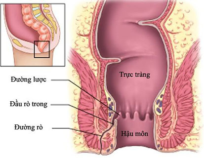 Rò hậu môn nên điều trị sớm và đúng cách. ro hau mon