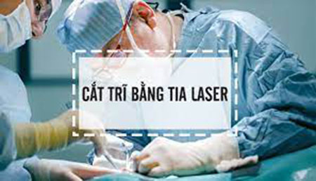 cắt trĩ bằng laser bao nhiêu tiền
